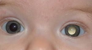 b_300_0_16777215_00_http___2.bp.blogspot.com_-KKQLIt_2B9Q_TgPtRFUxYXI_AAAAAAAAAuA_pSOKoz3eWYs_s320_retinoblastoma.jpg