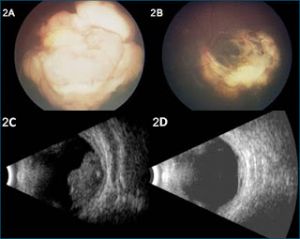 b_300_0_16777215_00_http___3.bp.blogspot.com_-1o58UWRqBGI_TgPsqlETKtI_AAAAAAAAAt8_A7cDNMfwpug_s320_retinoblastoma_US_pre_pos.jpg