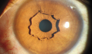 b_300_0_16777215_00_http___hypescience.com_wp-content_uploads_2017_03_colarinho-iris-saliente-.png