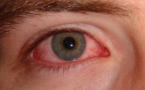 b_300_0_16777215_00_http___www.visaolaser.com.br_blog_wp-content_uploads_2013_07_olhos-vermelho.jpg