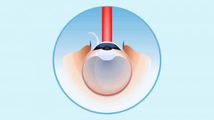 Ilustração representando laser sobre córnea após corte no epitélio.