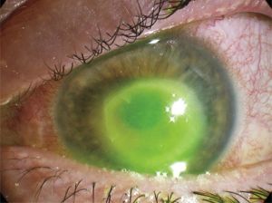 b_300_0_16777215_00_https___hypescience.com_wp-content_uploads_2019_07_infeccao-lentes-de-contato-cegueira-legal-838x625.jpg