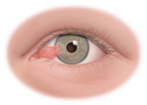 b_300_0_16777215_00_https___lh4.googleusercontent.com_-hpKsVfdIcqs_TXuKiaMvkeI_AAAAAAAAAoI_BhyV5zdhkow_s320_Pterygium_1.jpg