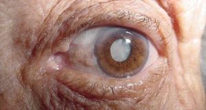 Catarata total senil 620x330