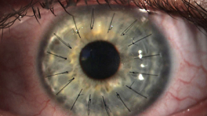 Transplante Cornea