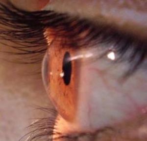 Células-troco retiradas de dente de leite podem reconstruir córnea