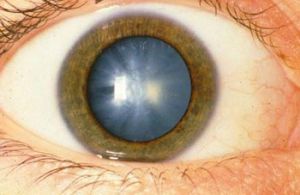A catarata pode ser evitada com medidas simples, como cuidar da alimentação A catarata pode ser evitada com medidas simples, como cuidar da alimentação