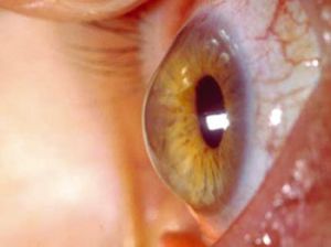 Novo laser promete combater o certeacone de forma rápida