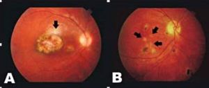 Cistos de T. gondii encontrados em retinas estruturalmente normais