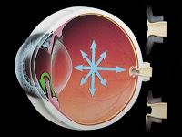 Glaucoma - o que é, como diagnosticar, como tratar