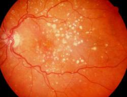 Degeneração macular: Doença pouco conhecida afeta milhões em todo o mundo