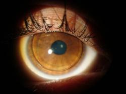 Lente mal ajustada agrava ceratocone Lente mal ajustada agrava ceratocone