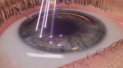 Cirurgia elimina alta miopia Cirurgia elimina alta miopia