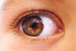 Estrabismo não tratado pode causar perda irreversível da visão