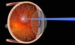 Fotocoagulação: laser para tratar os olhos