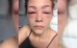 Após pintar as sobrancelhas e os cílios, jovem de 16 anos quase fica cega
