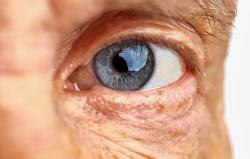 Degeneração macular relacionada à idade: tratamentos disponíveis para evitar a perda da visão Degeneração macular relacionada à idade: tratamentos disponíveis para evitar a perda da visão