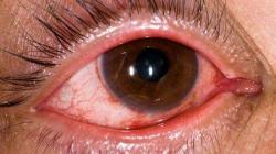 Contágio de conjuntivite aumenta no verão Contágio de conjuntivite aumenta no verão