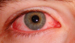 Saiba mais sobre Uveíte