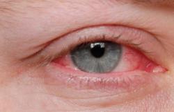 Oito dicas para controlar a alergia nos olhos