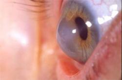 Ceratocone: saiba mais sobre a doença que deixa os olhos pontiagudos