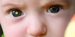 Retinoblastoma: tumor ocular em crianças
