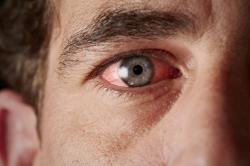 Alergias oculares: a prevenção como base do tratamento