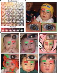 Aplicativo detecta problemas de visão em crianças a partir de fotos