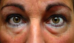 Dicas para amenizar os olhos inchados