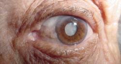 Cirurgia de catarata melhora o glaucoma, diz estudo