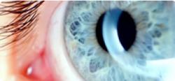 Mais informações sobre a cirurgia LASIK