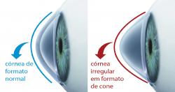 Saiba mais sobre o Ceratocone