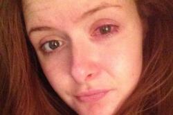 Jovem inglesa arranca a córnea ao usar lente por 10 horas