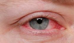 Estudo associa doenças oculares e depressão
