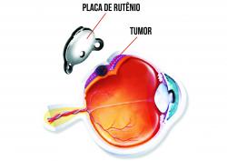Saiba mais sobre o Glaucoma