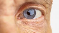 Dia Mundial da Visão: catarata e glaucoma são as principais causas de cegueira evitável Dia Mundial da Visão: catarata e glaucoma são as principais causas de cegueira evitável