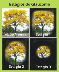 10 dúvidas comuns sobre o Glaucoma 10 dúvidas comuns sobre o Glaucoma