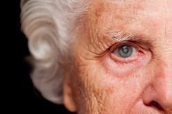 Catarata é a causa número um de cegueira na população mundial